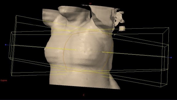 Radiotherapy Planning scan - © Victoria Mapplebeck